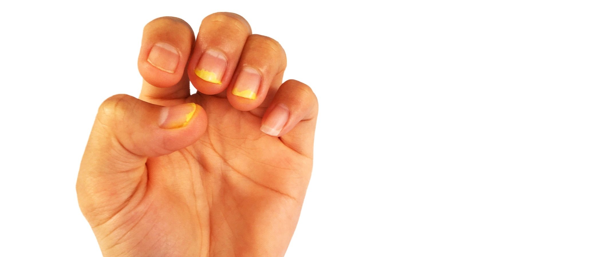 Tsitrosept para el tratamiento del hongo de las uñas las revocaciones