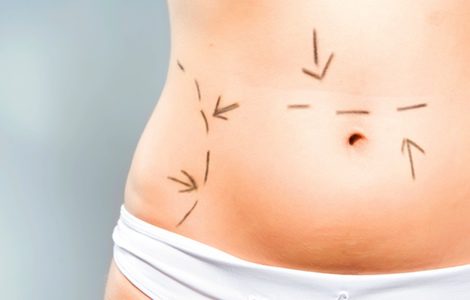 La lipoescultura elimina la grasa de zonas localizadas del cuerpo