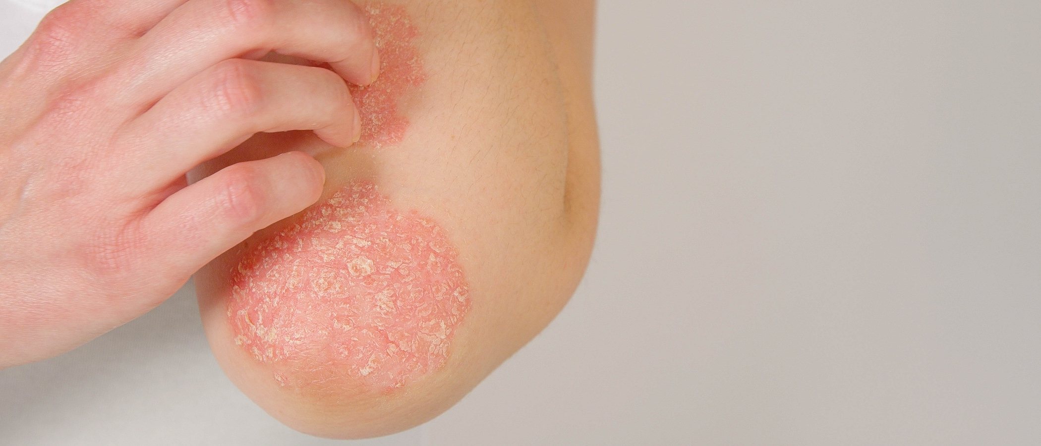 Herpes zóster: cómo disimularlo y curarlo