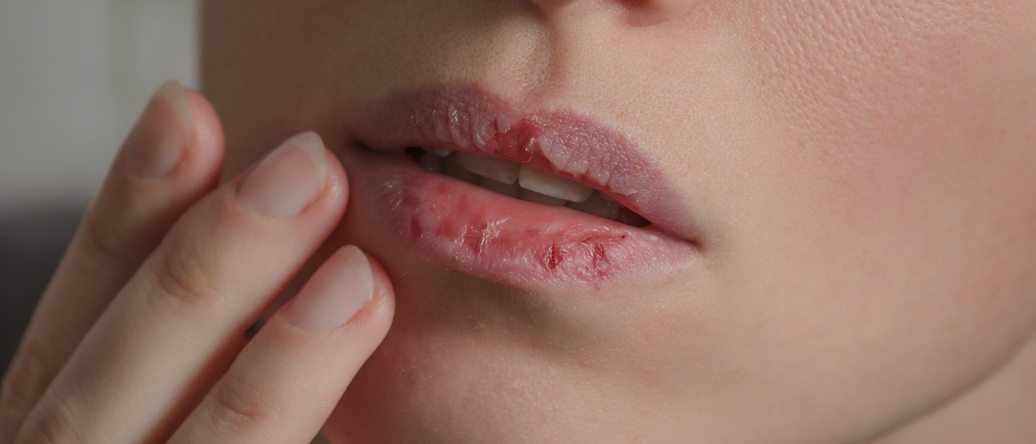 Remedios naturales para curar los labios partidos