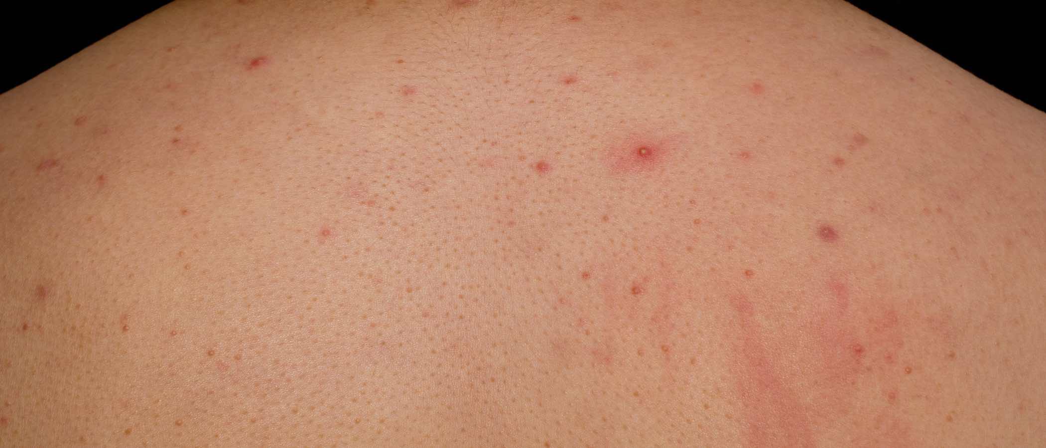 Foliculitis y forunculosis