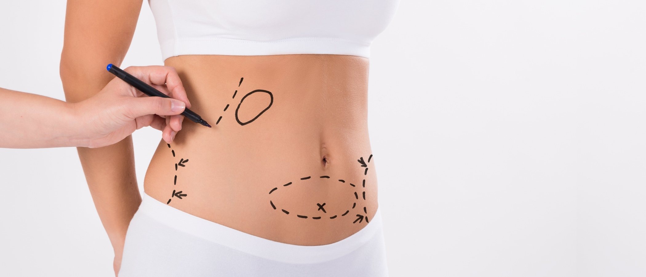 Liposucción: consejos antes de la operación