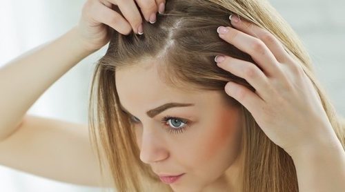¿Cómo prevenir la caspa?