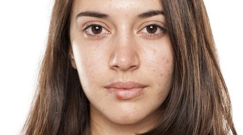 Herpes en la cara: tratamiento y prevención