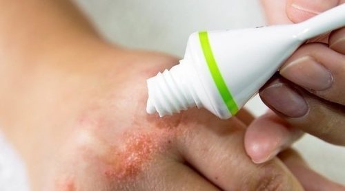 Cómo elegir la mejor crema hidratante para pieles atópicas